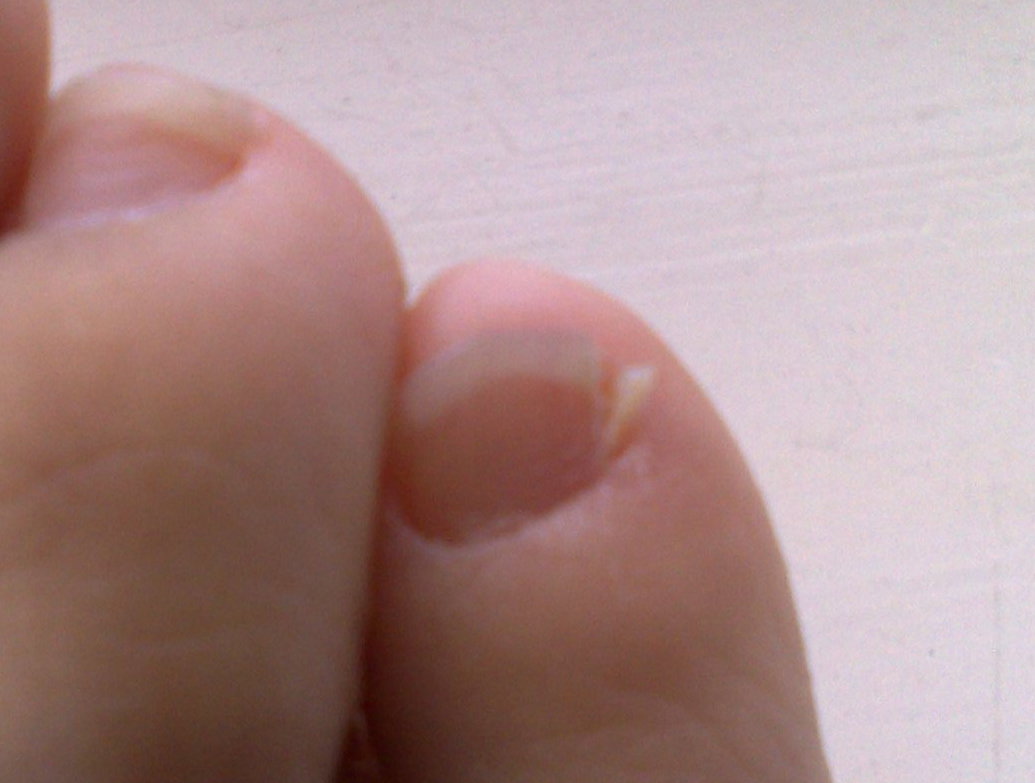 The Mongoloid toenail on a right foot.