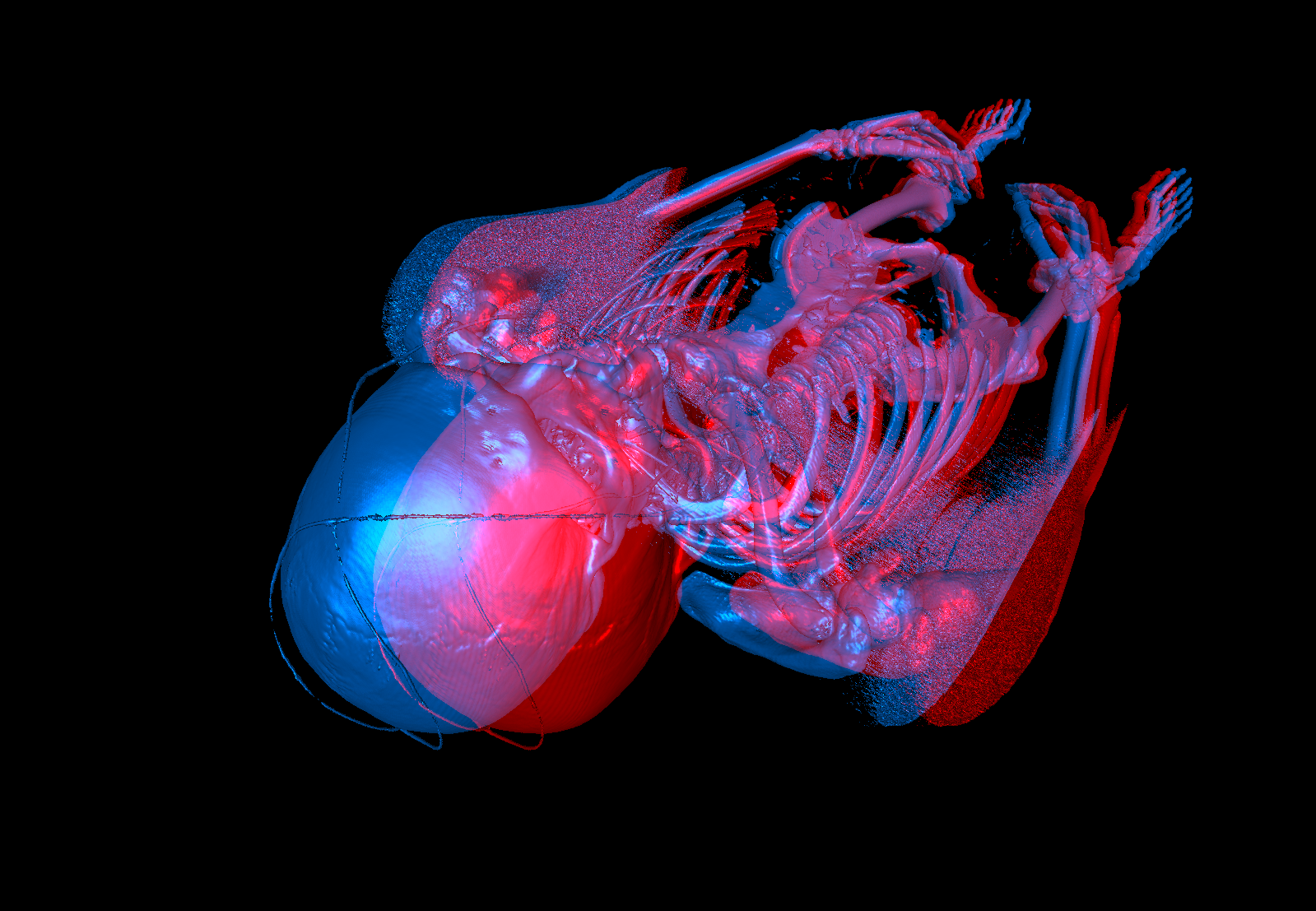  An anaglyph image of a human body rendered with ImageVis3D.