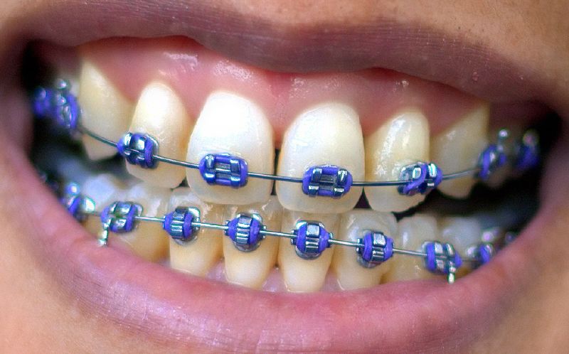 Sukhia Dental Surgery,Karachi Pakistan Intra-oral view of patient with fixed orthodontic braces dental braces.
