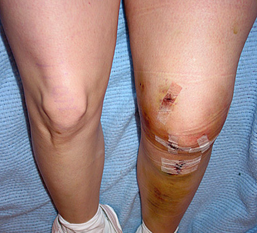 Post surgery on left knee, high swelling causing discomfort Post surgery on left knee, high swelling causing discomfort