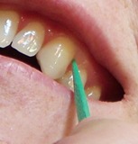 Gratifying an attack of gingival CMSN.