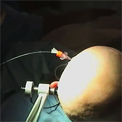A small flexible laser probe is guided to the intended target area.