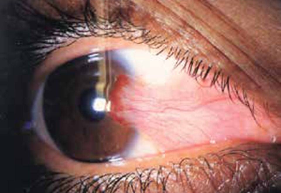 Bleeding pterygium of Imtiaz